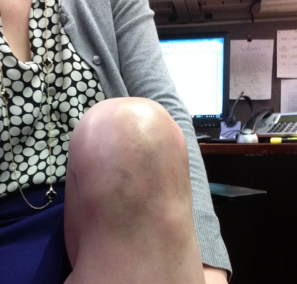 Bruised Knee