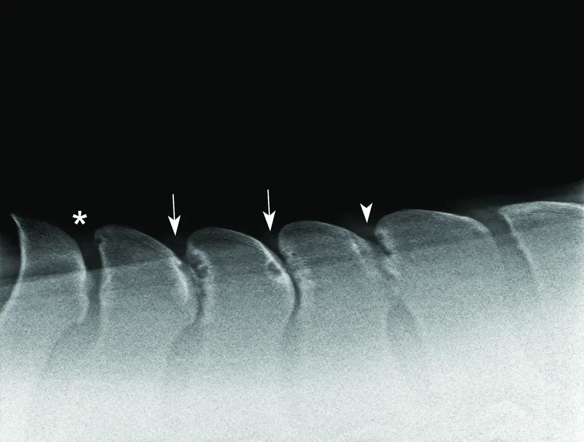 A horse with four sites of impingement with bone remodeling, suspected to be causing the horse’s pain under saddle due to kissing spines.