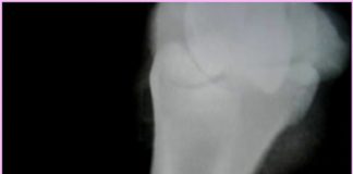 Radiograph of a Pastern Fracture